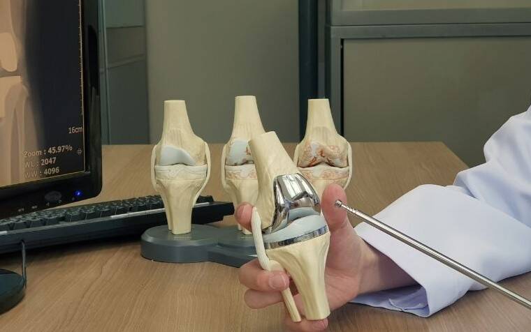 How customised knee implants personalise knee replacement