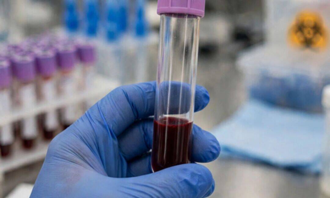 Blood test may detect Alzheimer’s years before symptoms: Study