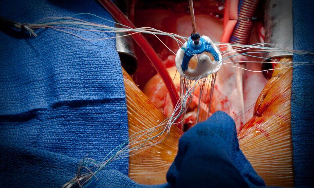 68-year-old kidney transplant patient gets zero-contrast TAVR