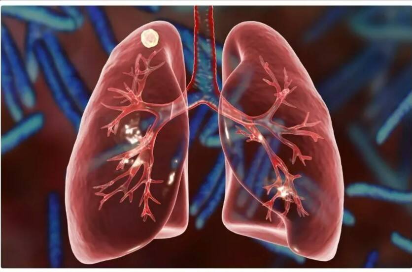 Why are lung diseases often diagnosed too late?