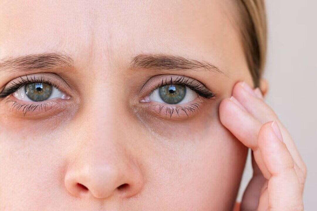 What is ferritin face?                       