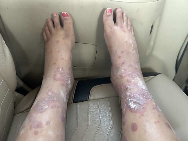 Flyer claims she got fungal infection after taking Akasa Air flight, says 'Seats were unhygienic'