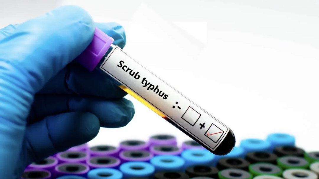AP reports 1,566 scrub typhus cases, 9 suspected deaths in 2025