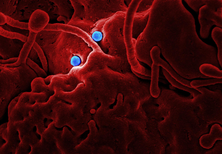 X-Ray alone may lead to wrong TB treatment: Experts