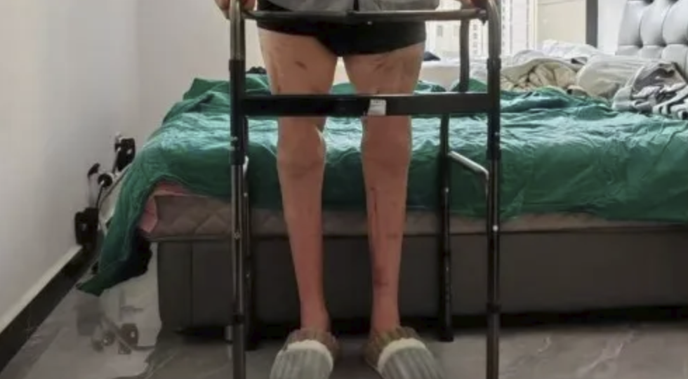 World's first double-thigh replantation helps amputee walk again