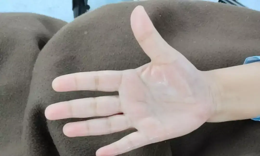 Woman treated for palmar hyperhidrosis at Mumbai hospital 