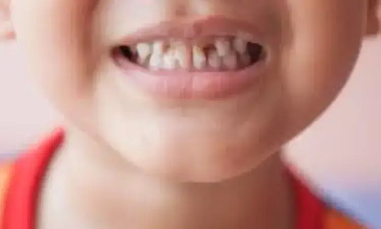 Higher vitamin D during pregnancy may protect baby's teeth: Study