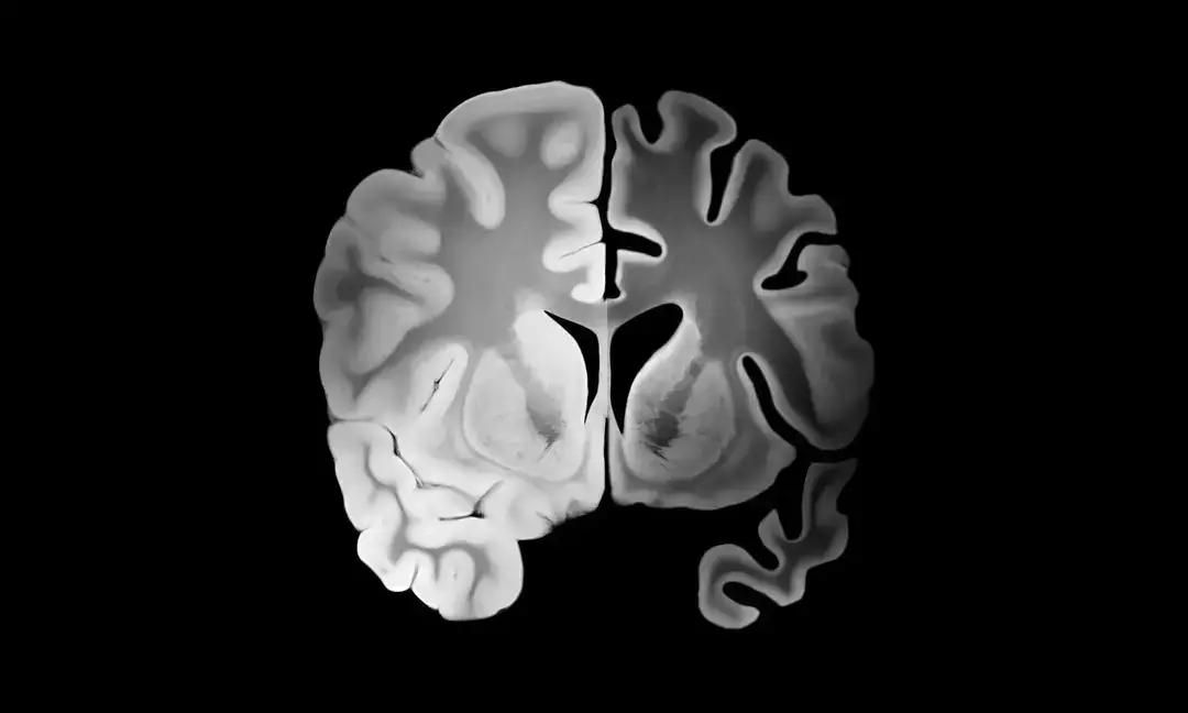 Study suggests Alzheimer's damage could be reversible