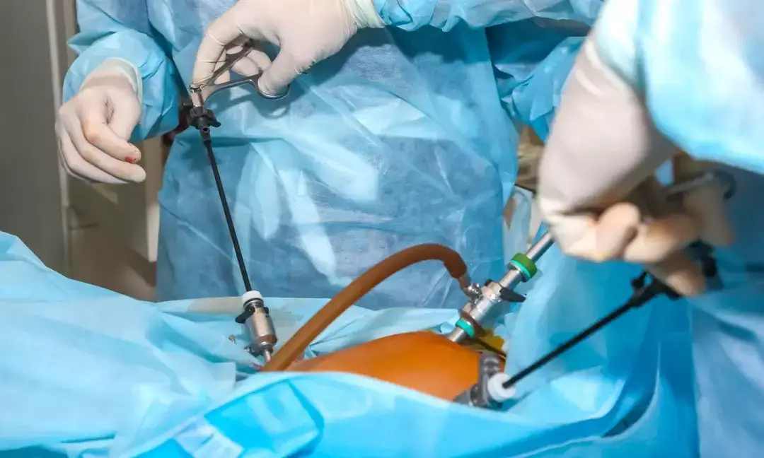 Pitampura hospital performs complex laparoscopic hernia repair