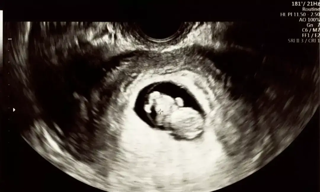 Antibiotics in pregnancy may raise newborns’ GBS risk: Study