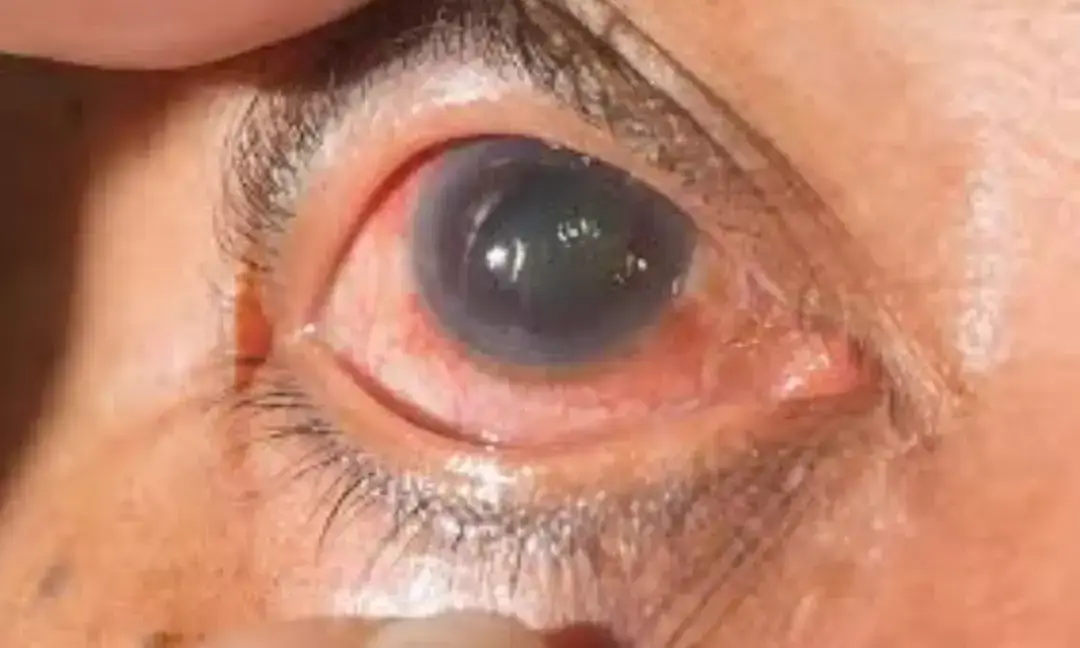 12 million Indians affected by glaucoma