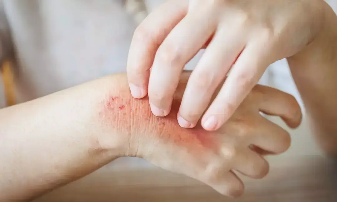 Digvijaya Singh raises alarm over skin disease outbreak in Betul