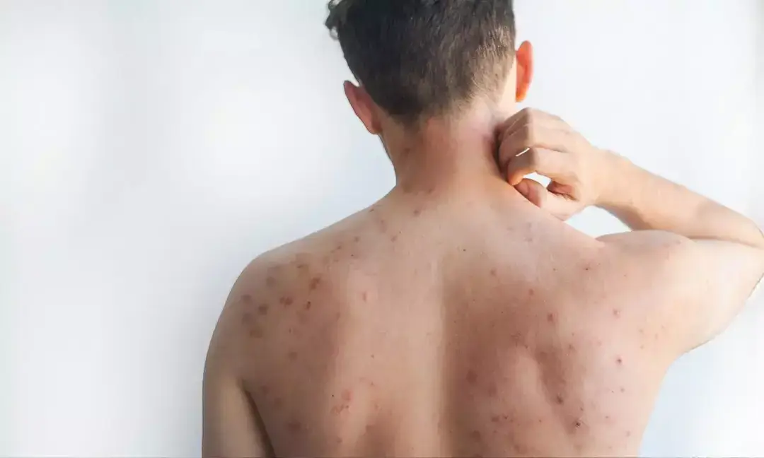 Bangladesh measles outbreak worsens amid rising cases 