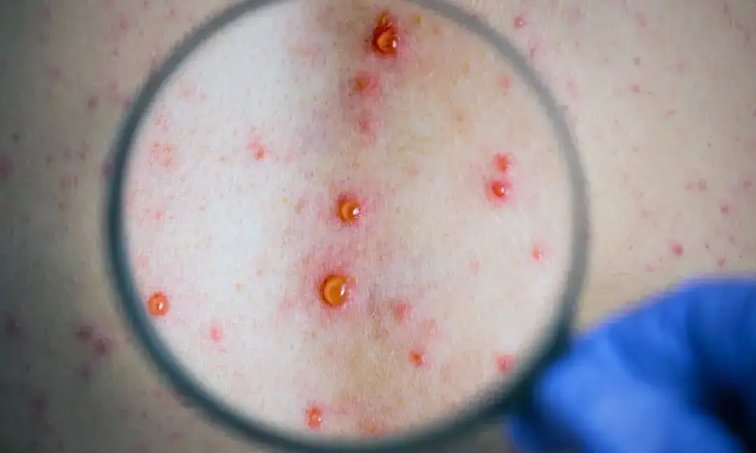 Pakistan reports first mpox case in Karachi, warns of local spread