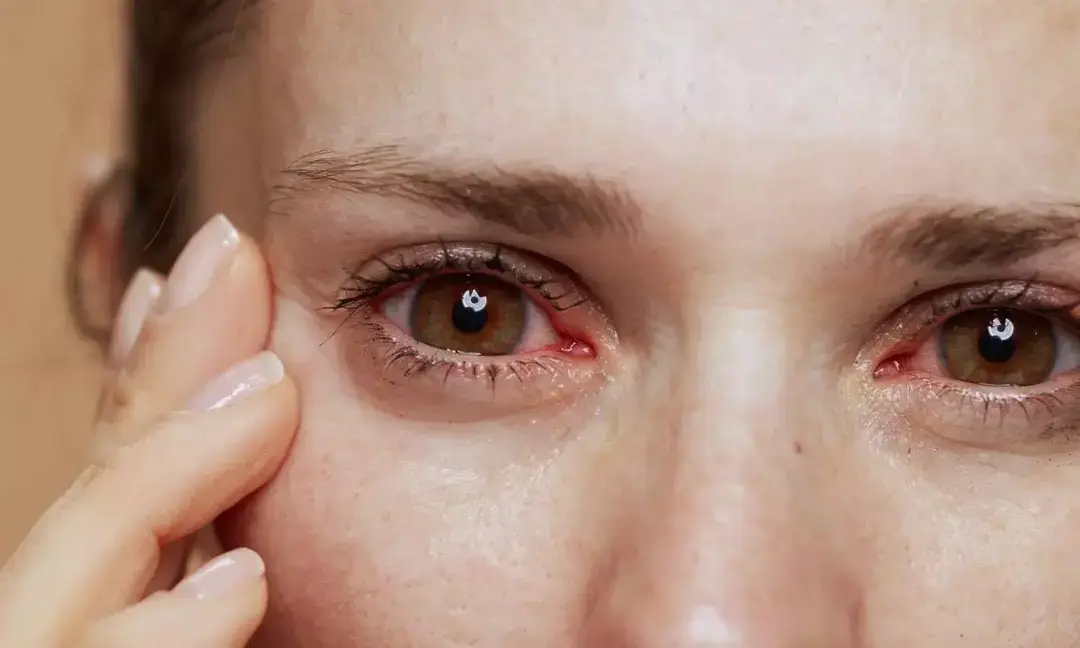 AIIMS trials Lactoferrin tablet from mother’s milk to treat eyes