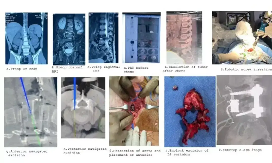 Robotic surgery saves 10-year-old with rare spinal cancer