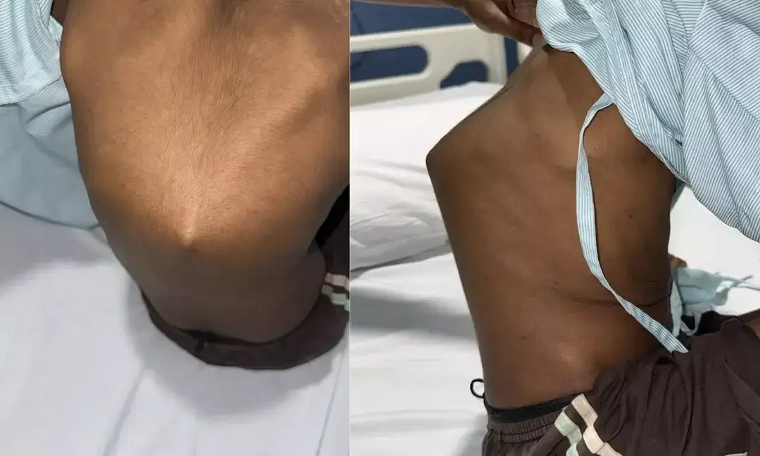 8-year-old walks again after complex spinal TB surgery