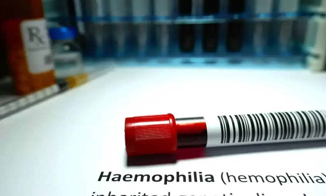 669 Haemophilia patients get free treatment in Ahmedabad