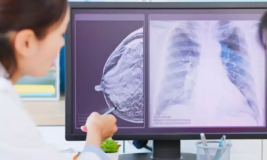 Study warns Asbestos exposure may be missed in lung cancer
