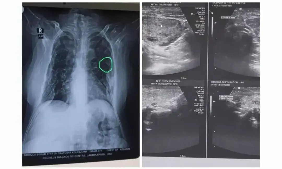 Breast lump evaluation uncovers rare hormonal disorder