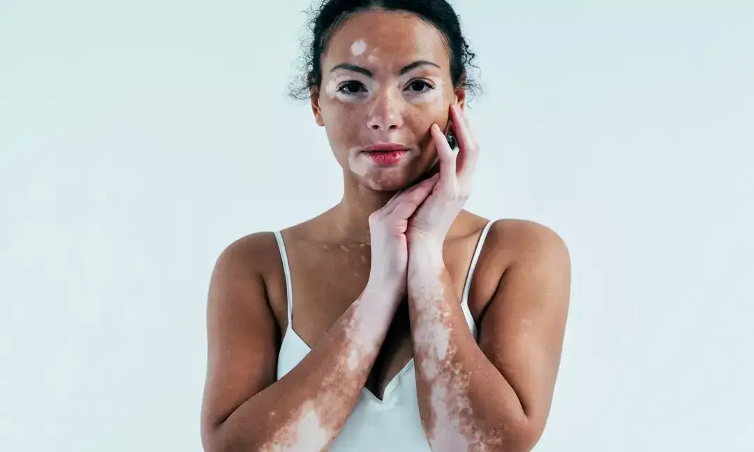 Understanding the facts about vitiligo