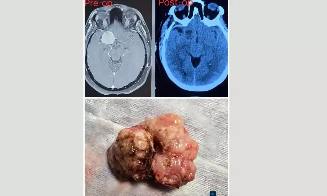 4.5 cm brain tumour removed in complex surgery