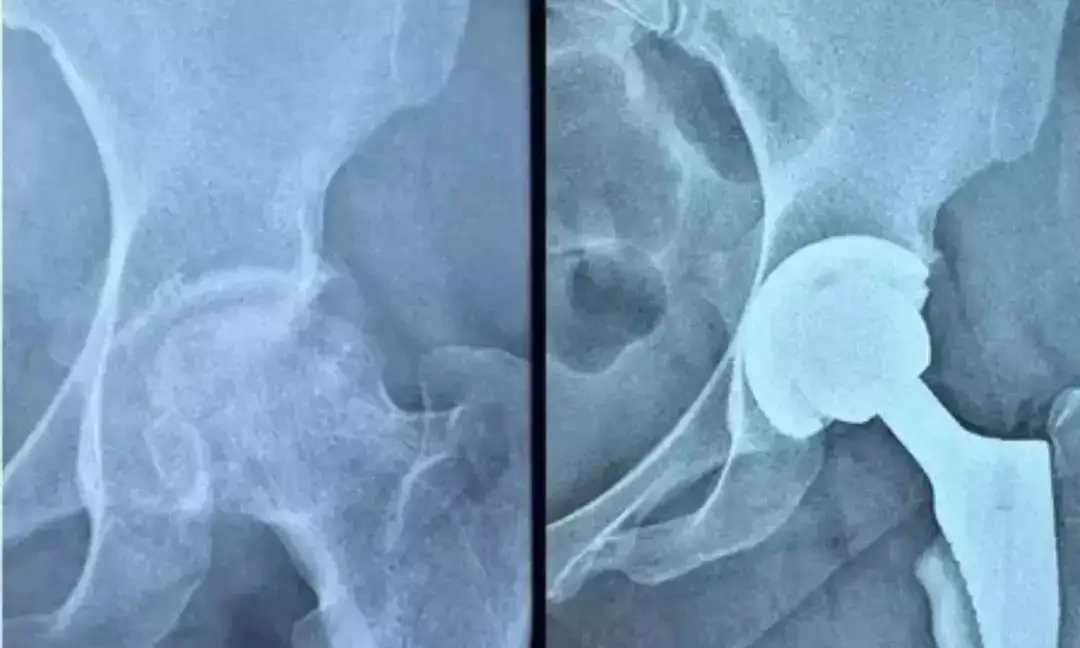 Rare blood disorder patient gets free hip replacement