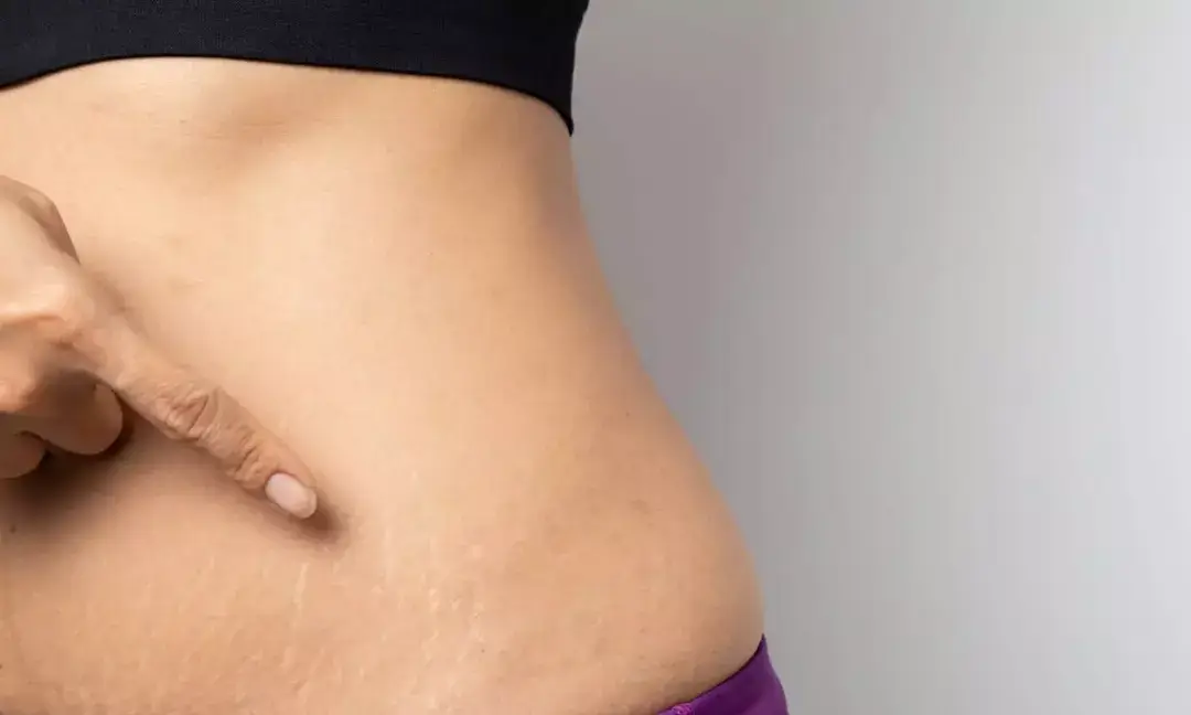 Postpartum skin changes: Simple tips for new moms