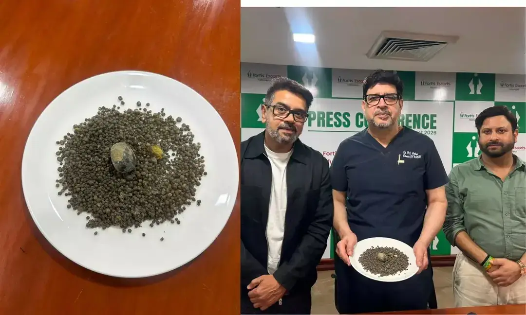 41-yr-old has over 4,000 gallstones removed in 45-min surgery